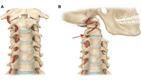 tratamentul artrozei de gradul IV durere de spate în partea dreaptă